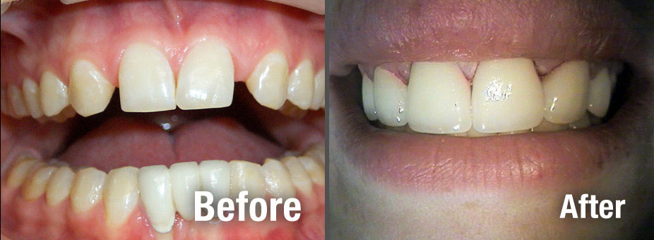 Before and after Smile Makeovers in Pryor, OK