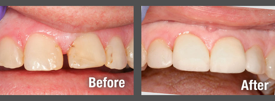 Before and after Smile Makeovers in Pryor, OK