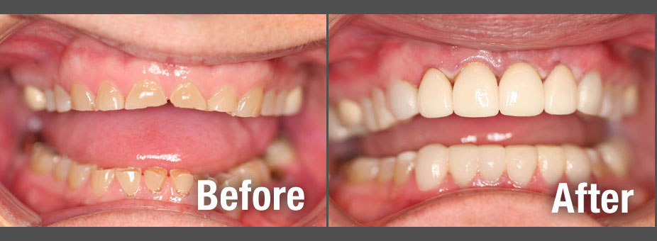 Before and after Smile Makeovers in Pryor, OK